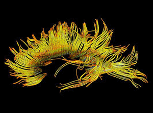 Image: Colored 3D diffusion tensor imaging (DTI) scan of the bundles of white matter nerve fibers in the cerebellum (Photo courtesy of Simon Fraser / Science Photo Library).